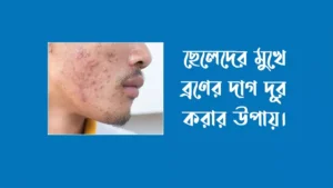 ছেলেদের মুখেৱ ব্রণ দূর করার উপায়
